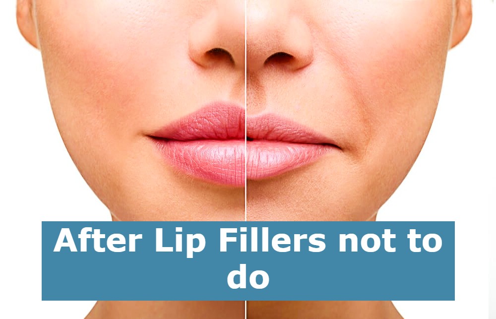 After Lip Fillers not to do