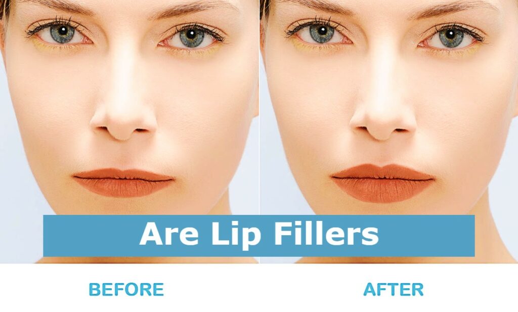 Are Lip Fillers?