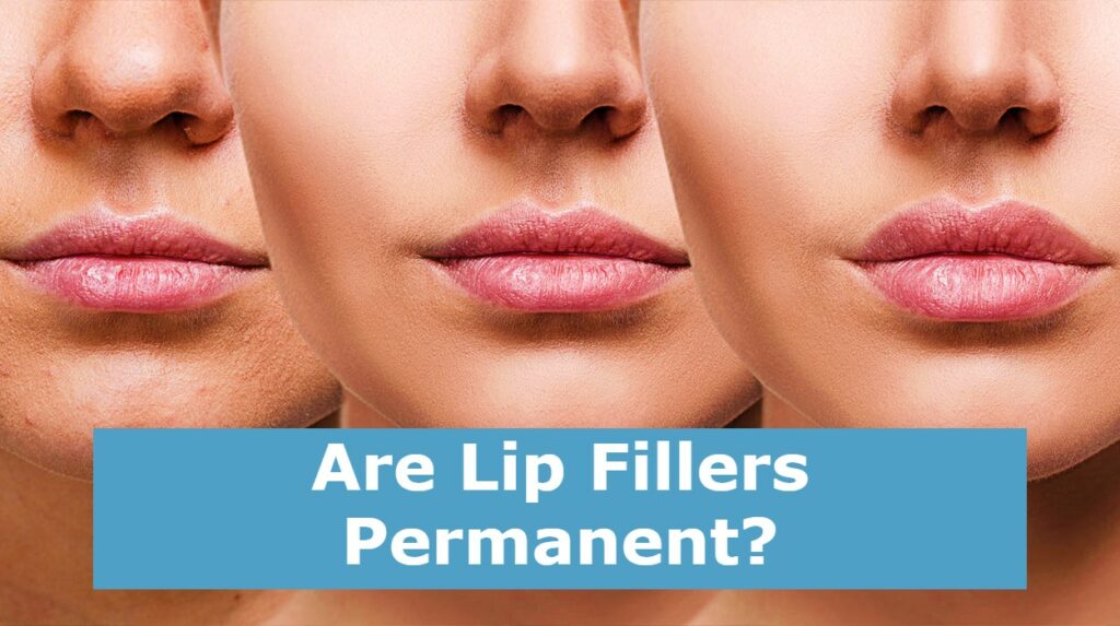 Are Lip Fillers Permanent?