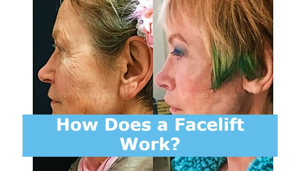 How Does a Facelift Work?