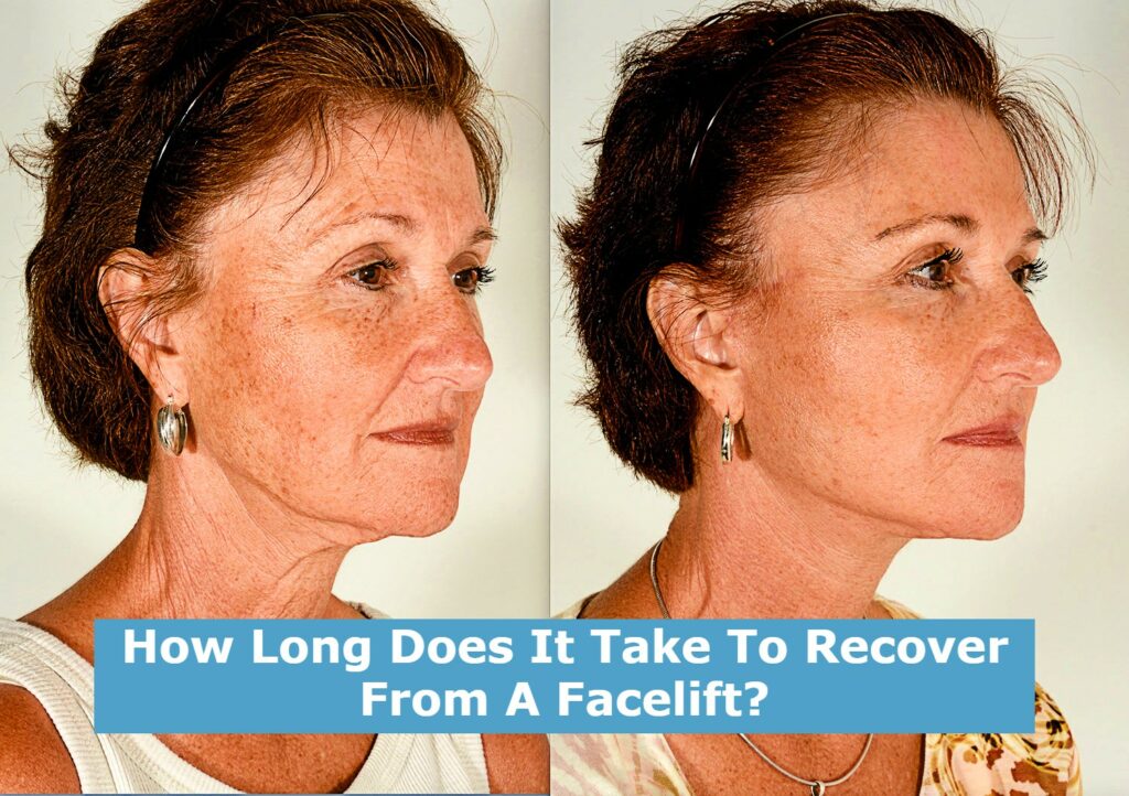 How Long Does It Take To Recover From A Facelift?