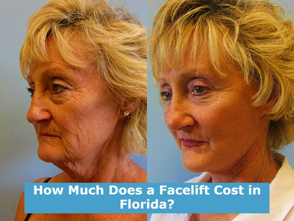 How Much Does a Facelift Cost in Florida?