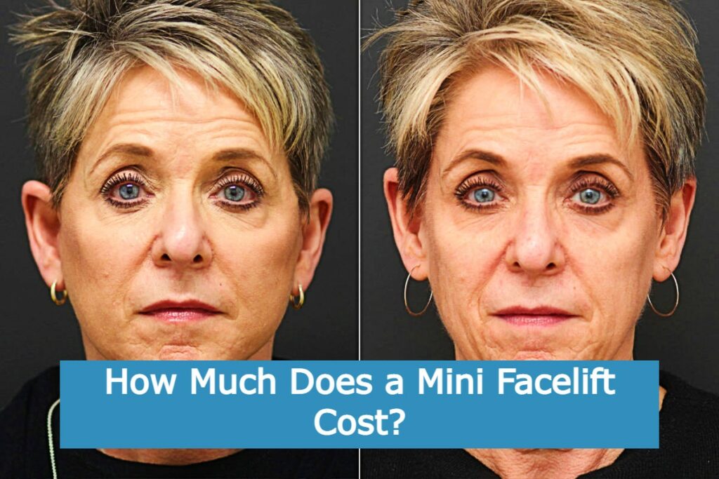 How Much Does a Mini Facelift Cost?