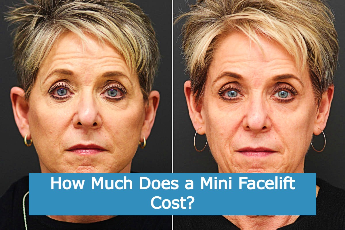 How Much Does a Mini Facelift Cost? ELU Health