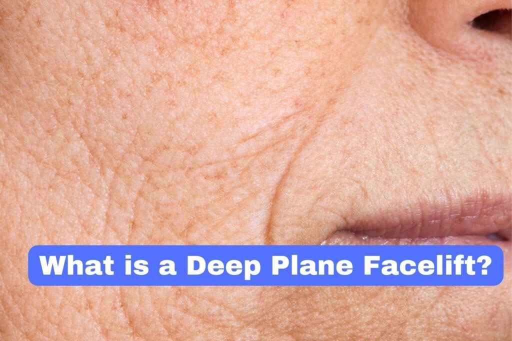 What is a Deep Plane Facelift?