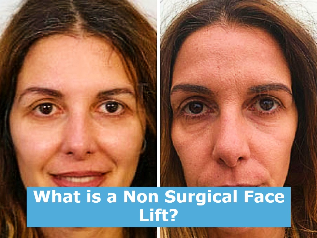 What is a Non Surgical Face Lift?