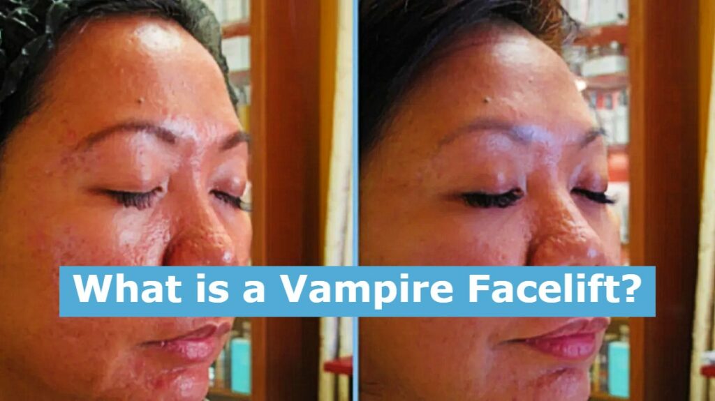 What is a Vampire Facelift?